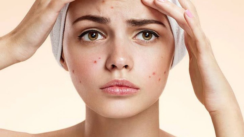 Nhuỵ hoa nghệ tây giúp điều trị và ngăn ngừa tình trạng mụn trứng cá