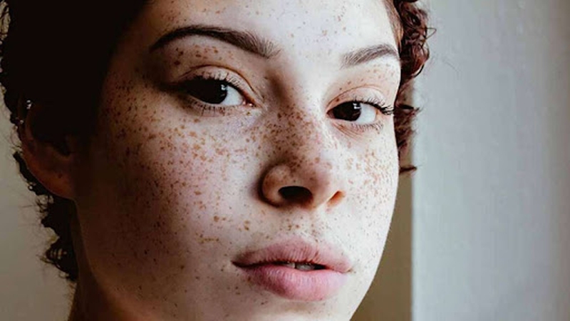 Làm sao để phân biệt tàn nhang và nốt ruồi