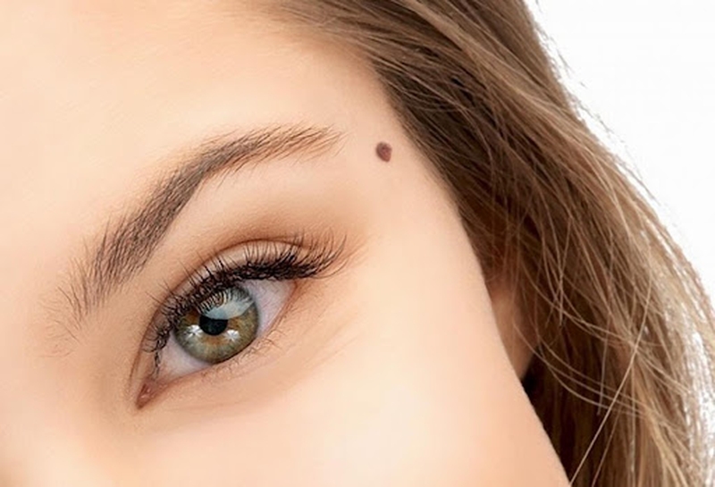 Làm sao để phân biệt tàn nhang và nốt ruồi