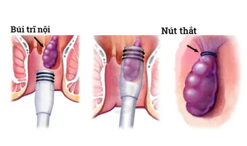 Làm sao để phòng ngừa và điều trị bệnh trĩ? 1