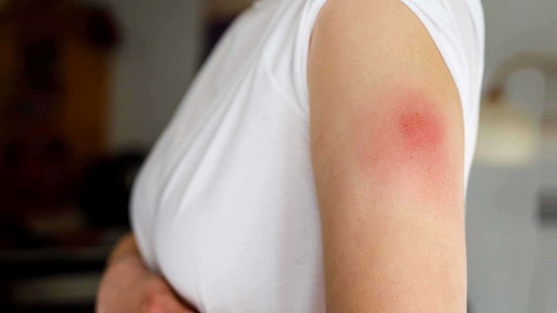 Làm sao để xử lý khi hạch lao bị vỡ sau tiêm phòng lao 1