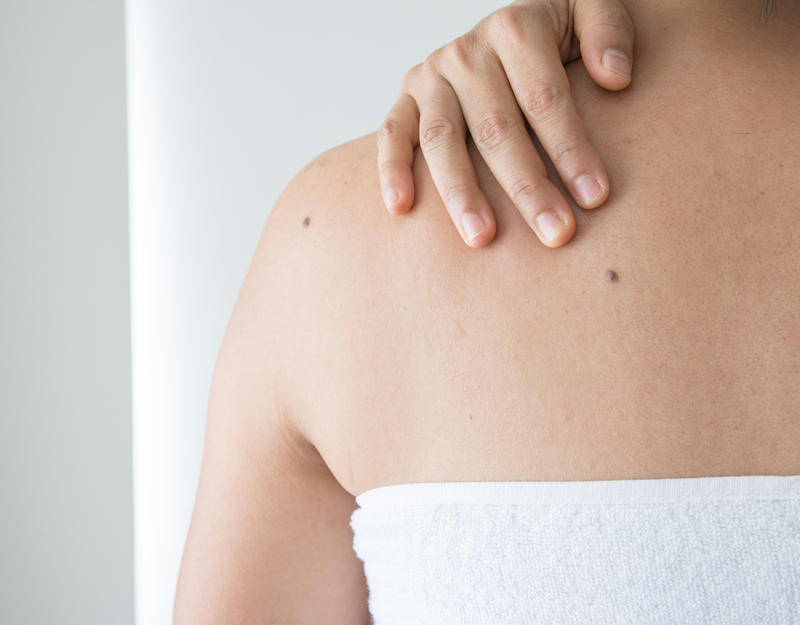 Nốt ruồi xuất hiện ở nhiều vị trí khác nhau trên cơ thể