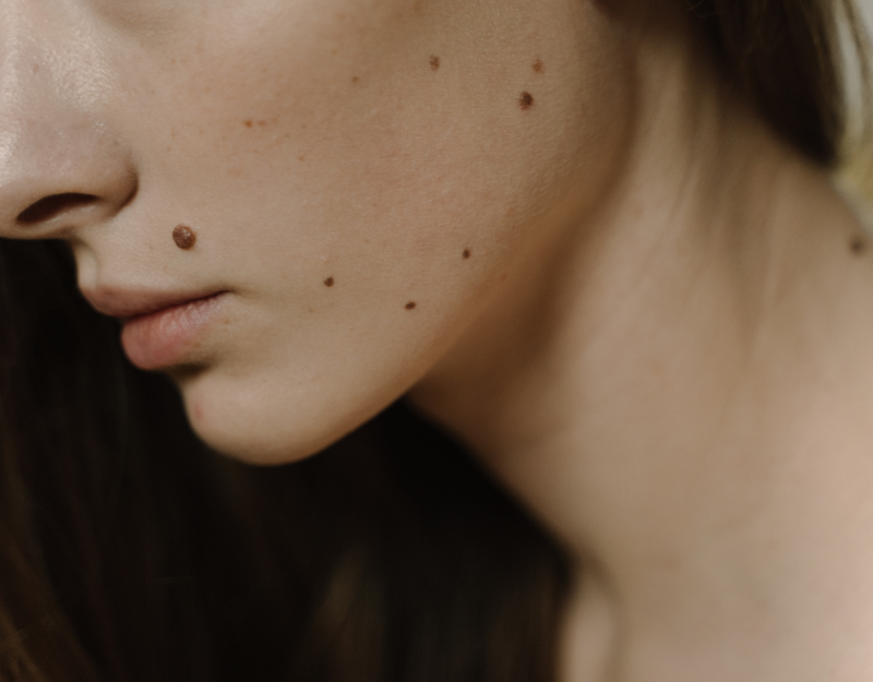 Tẩy nốt ruồi bằng kem đánh răng - phương pháp được nhiều chị em sử dụng