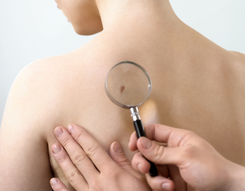 Không nên lạm dung phương pháp tẩy nốt ruồi bằng kem đánh răng