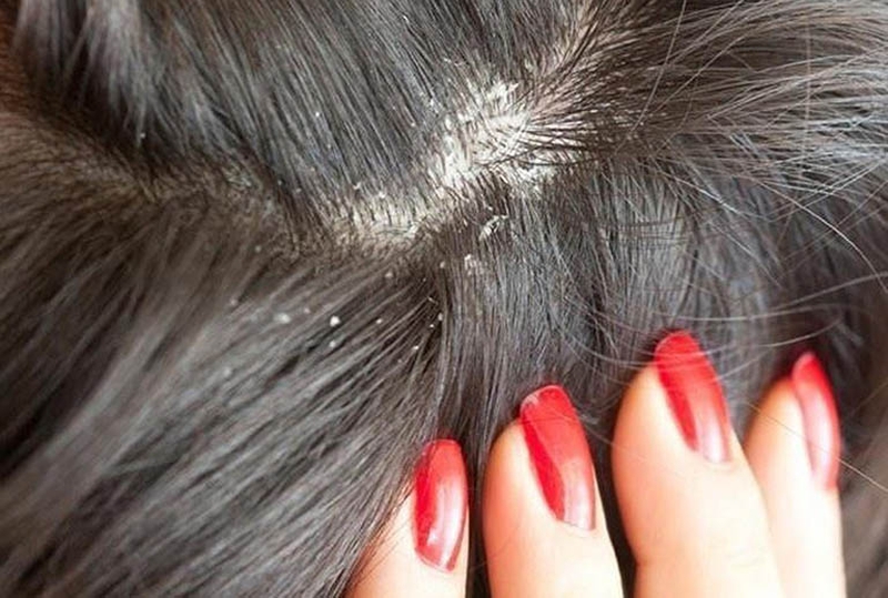 Làm sao tránh sai lầm khi trị gàu nặng