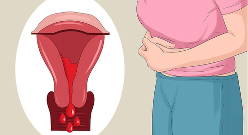 Góc giải đáp: Làm thế nào để biết lạc nội mạc tử cung?