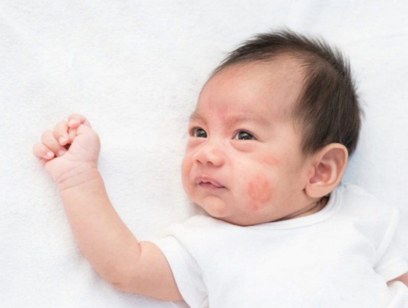 ​​​​​​​Làm thế nào để điều trị chốc lở ở trẻ em 1