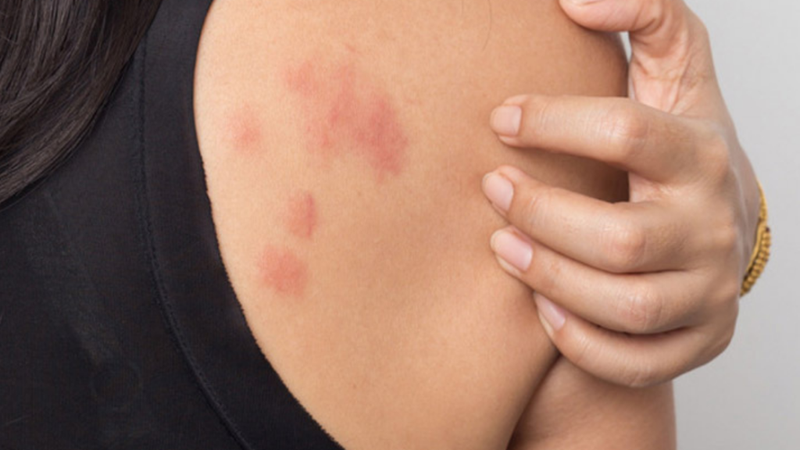 Làm thế nào khi bị dị ứng lông chó? Nguyên nhân và triệu chứng 1