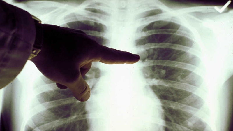 Làm thế nào ô nhiễm không khí có thể dẫn đến một số bệnh ung thư? 2