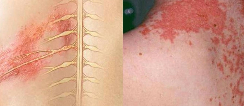 Làm thế nào phân biệt zona thần kinh và giời leo  1