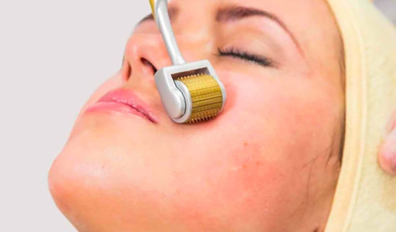 Lăn kim có đau không? Những điều nên biết về quy trình và sau khi lăn kim 1