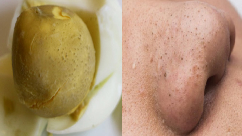 Nhiều người chia sẻ nhau về tác dụng lăn trứng gà hút mụn