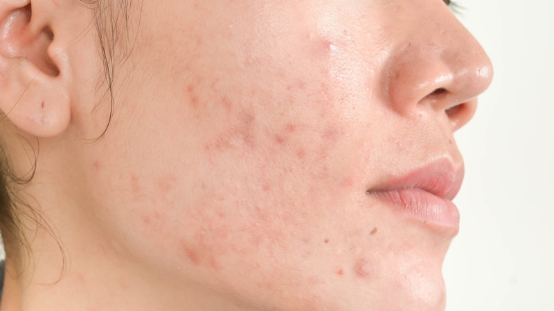 Lăn trứng gà hút mụn có thể làm tình trạng mụn tồi tệ hơn