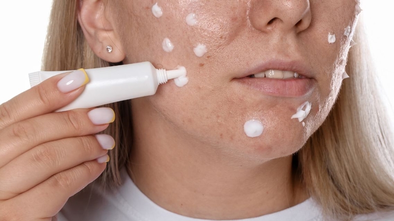 Nên đi khám da liễu để được tư vấn trị mụn chuẩn y khoa