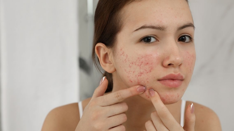 Không có cơ sở khoa học chứng minh hiệu quả trị mụn bằng cách lăn trứng gà