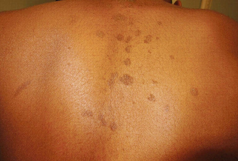 Cách trị lang beng đen hiệu quả và nhanh chóng