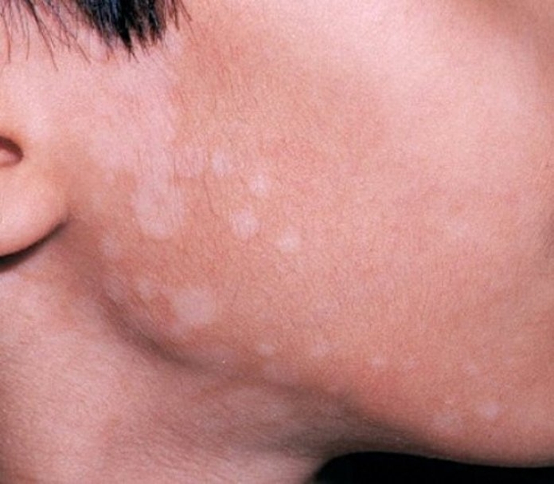 Triệu chứng đáng chú ý nhất của bệnh lang ben da mặt chính là sự xuất hiện của các vùng da bị đổi màu