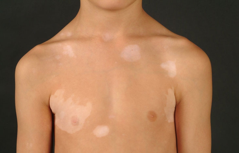 Lang ben không gây nguy hiểm nhưng nó có thể ảnh hưởng đến thẩm mỹ bởi các mảng da sáng tối, không đều màu