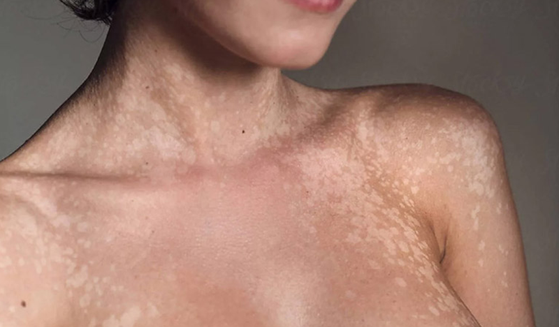 Lang ben lâu năm gây ảnh hưởng đến sắc tố da