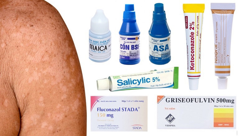 Tùy vào mức độ nghiêm trọng của bệnh mà bác sĩ có thể chỉ định dùng thuốc bôi ngoài da hay thuốc uống