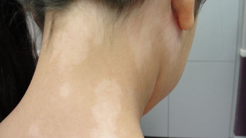 Lang ben là bệnh lý ngoài da thường xuất hiện ở tuổi dậy thì