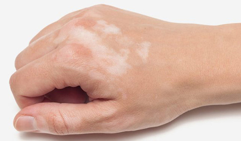 Lang ben là bệnh lý ngoài da thường xuất hiện ở tuổi dậy thì