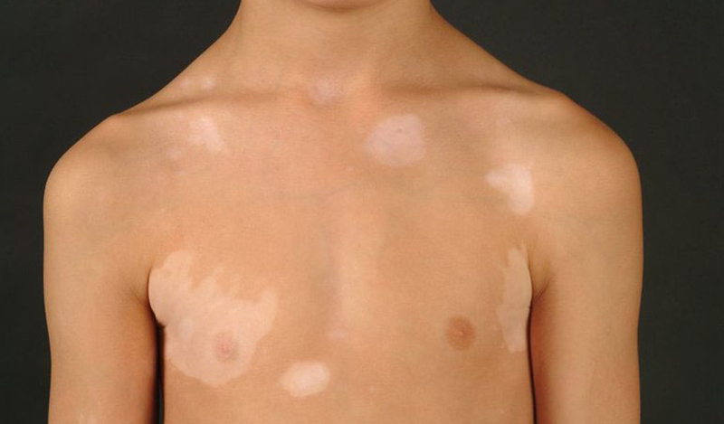 ​​​​​​​Bệnh lang ben tuổi dậy thì rất dễ tái phát