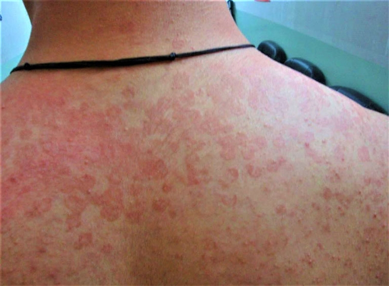 Giải đáp thắc mắc lang beng đỏ có lây không 2