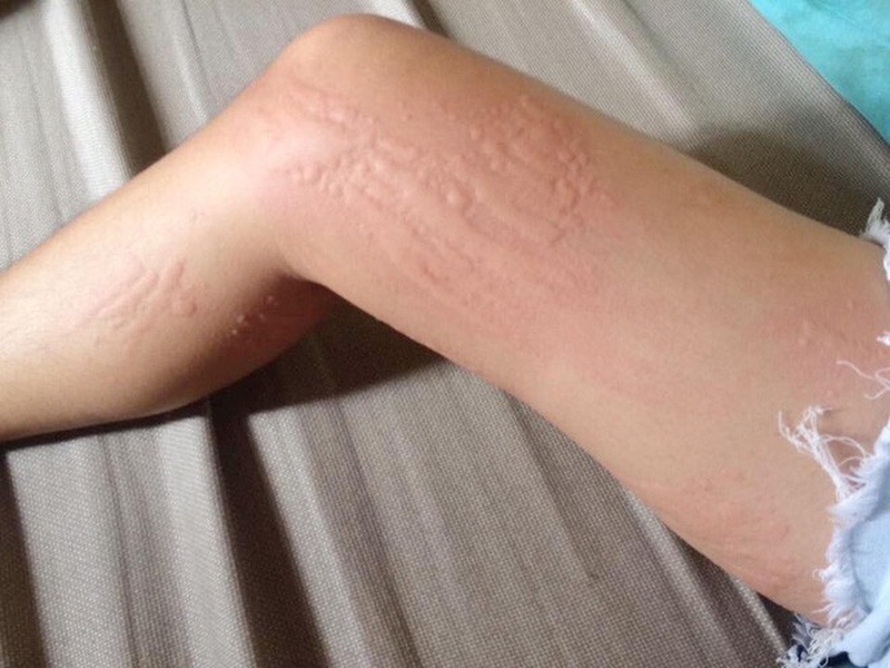 Tại sao da bị dị ứng khi gặp thời tiết lạnh ? Cách khắc phục và phòng ngừa 2