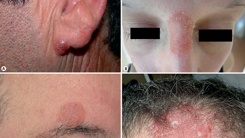 Lao da: Nguyên nhân, triệu chứng và điều trị 1