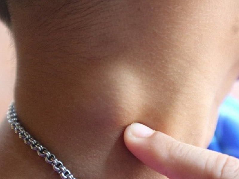 Lao hạch là gì? Dấu hiệu của bệnh lao hạch 2