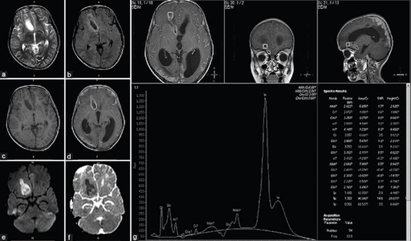 Lao màng não điều trị bao lâu thì khỏi? 3