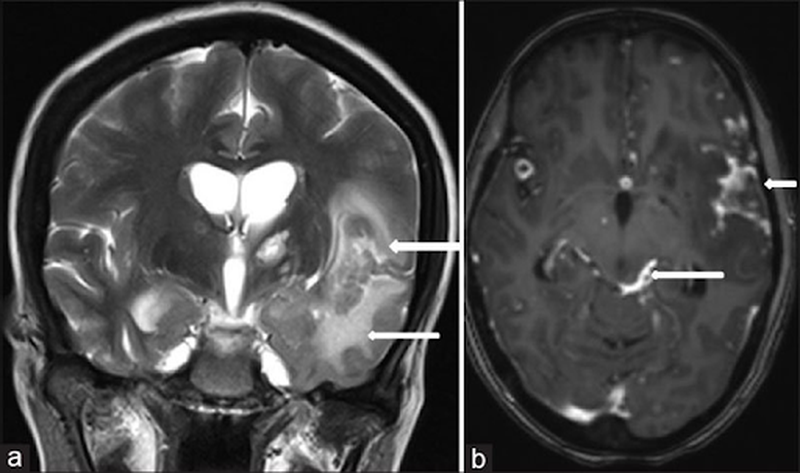 Lao màng não giai đoạn cuối có thật sự nguy hiểm? 3