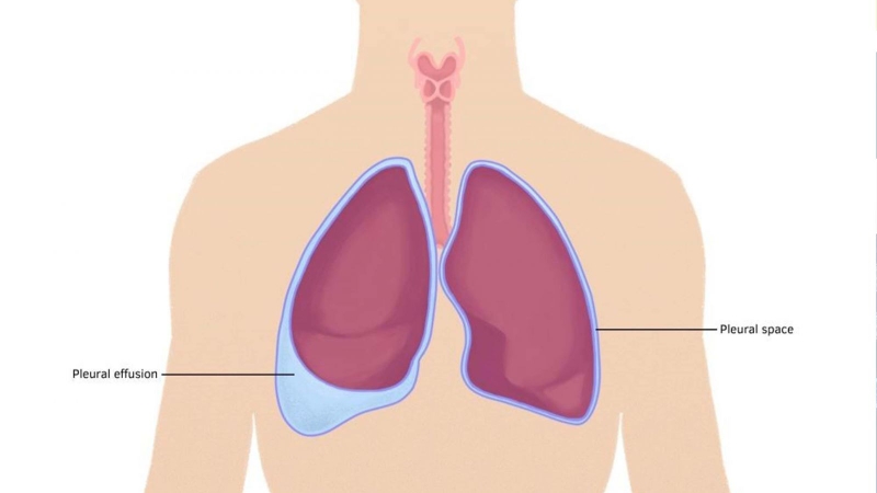lao màng phổi là gì