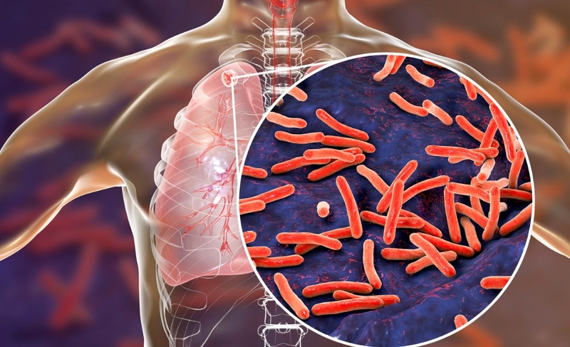 Lao phổi có nguy hiểm không? Làm thế nào để phòng ngừa hiệu quả 1