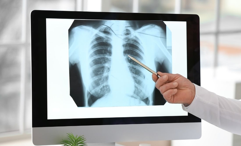 Lao phổi có nguy hiểm không? Làm thế nào để phòng ngừa hiệu quả 3