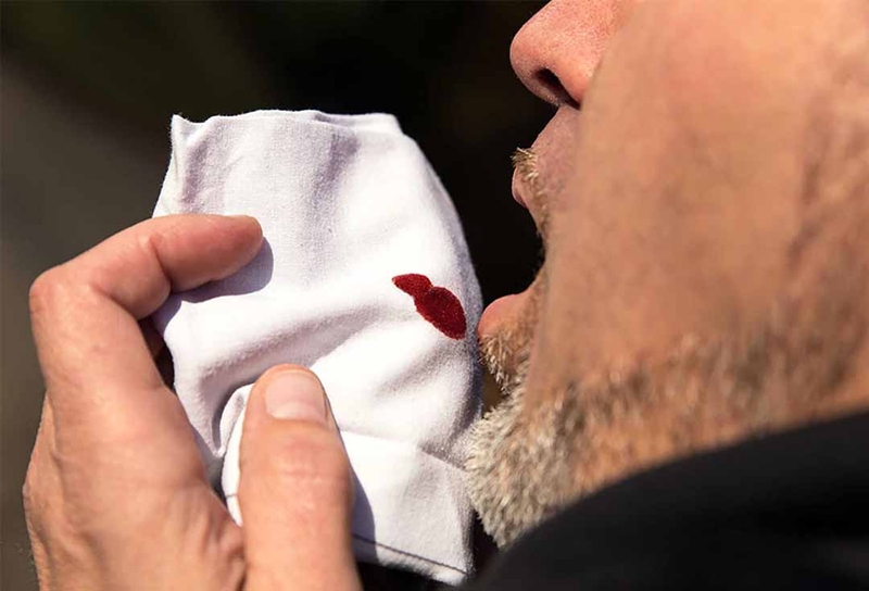 Lao phổi hết rồi có tái phát lại không? Chẩn đoán lao phổi tái phát 1