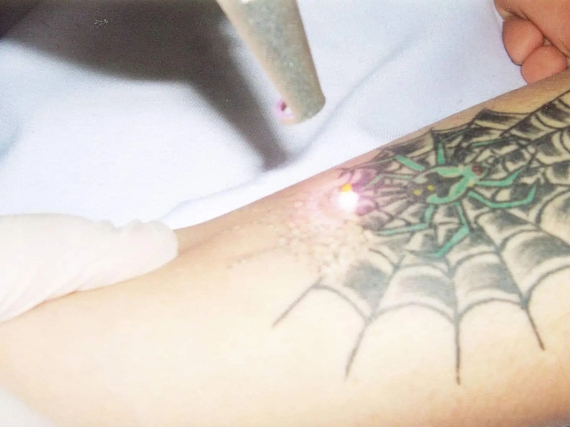 laser-yag-la-gi-ung-dung-cua-cong-nghe-laser-yag-trong-tham-my 3.jpg