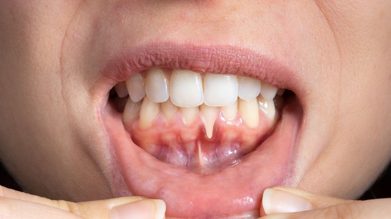 Cao răng tích tụ che lấp đi tình trạng tụt lợi đã diễn ra từ trước