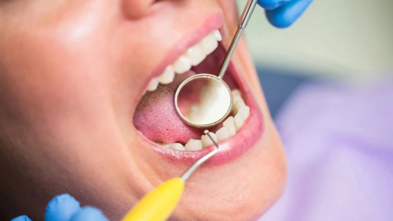 Lấy cao răng có hết hôi miệng không? Quy trình thực hiện 3