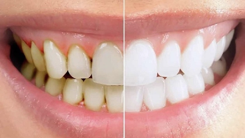 lay-cao-rang-het-bao-nhieu-tien-bao-lau-nen-lay-cao-rang-mot-lan 1