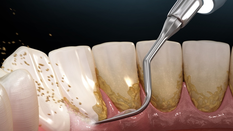 Lấy cao răng mất bao lâu? Khi nào nên lấy cao răng? 2