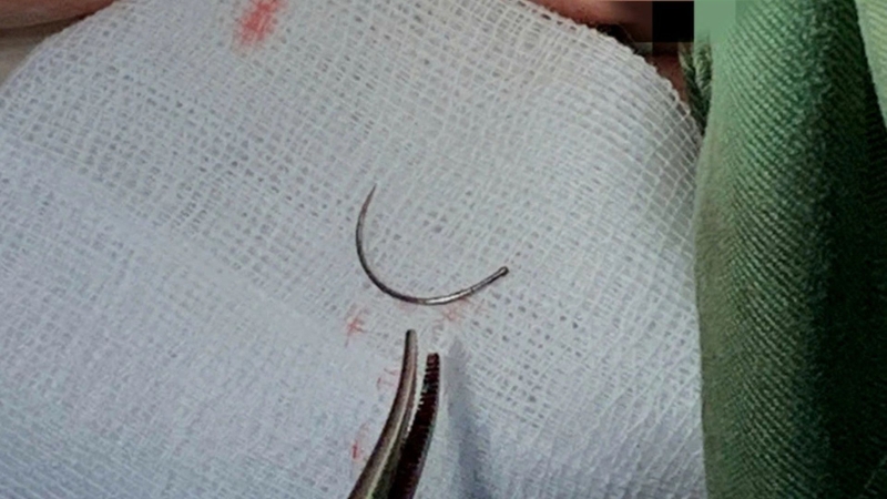 Kim khâu được phát hiện sau khi bệnh nhân xuất hiện cơn đau ở tầng sinh môn