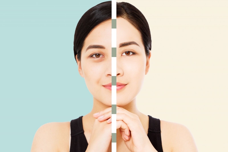 Cắt mí dưới là gì? Những thông tin cần biết trước khi phẫu thuật cắt mí dưới 1