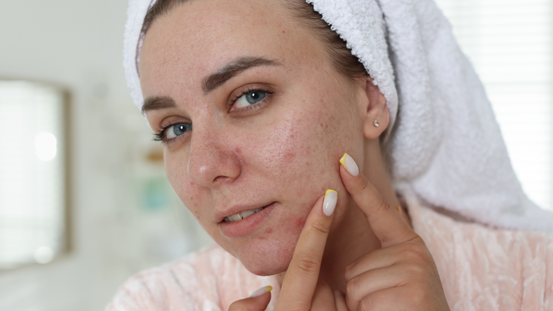 Không nên nặn mụn bằng móng tay vì dễ gây trầy xước, tăng nguy cơ viêm nhiễm