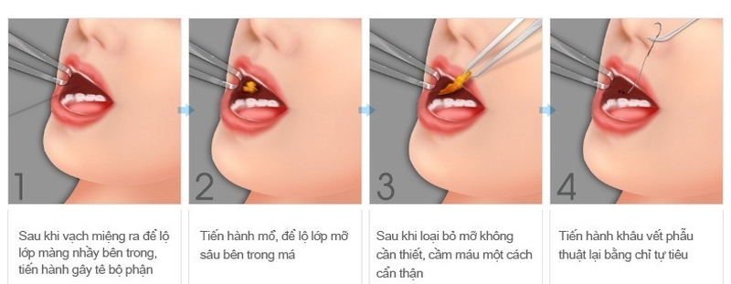 Thắc mắc: Lấy túi mỡ má bao lâu thì lành? 3