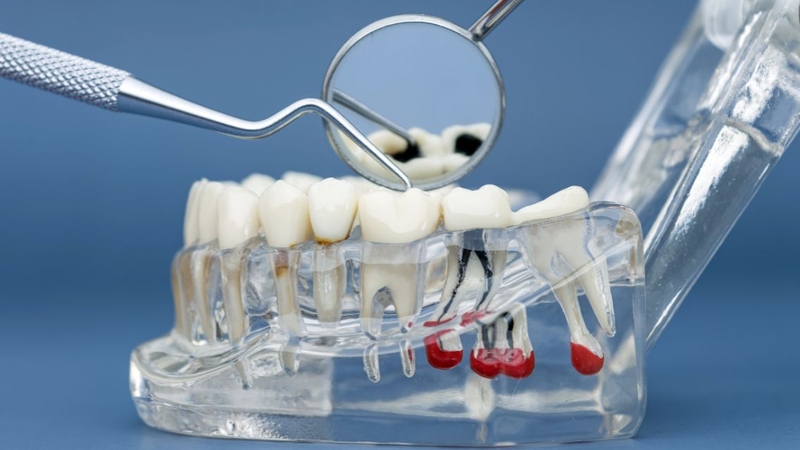 Nhiều người muốn tìm hiểu trước lấy tủy răng số 7 bao nhiêu tiền