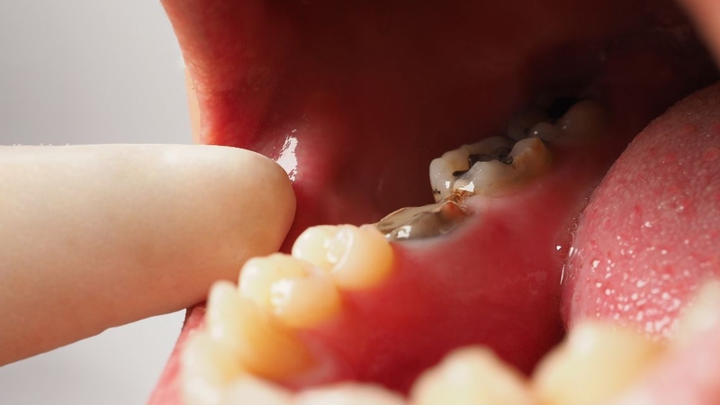 Không nên trì hoãn việc lấy tủy răng khi đã có chỉ định từ nha sĩ