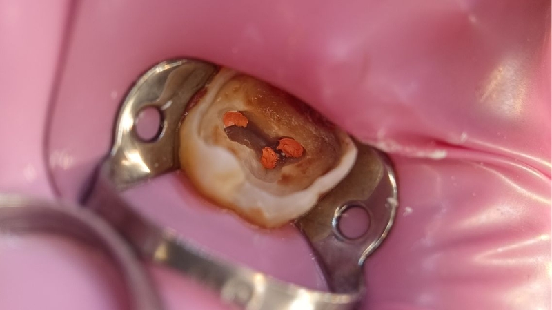 Nên chọn địa chỉ nha khoa uy tín để việc lấy tủy răng diễn ra an toàn