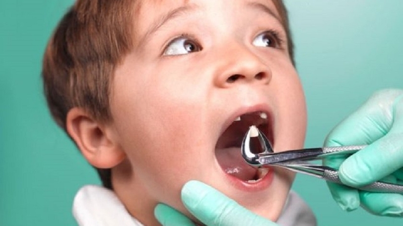 Lấy tủy răng sữa có nguy hiểm không? 2